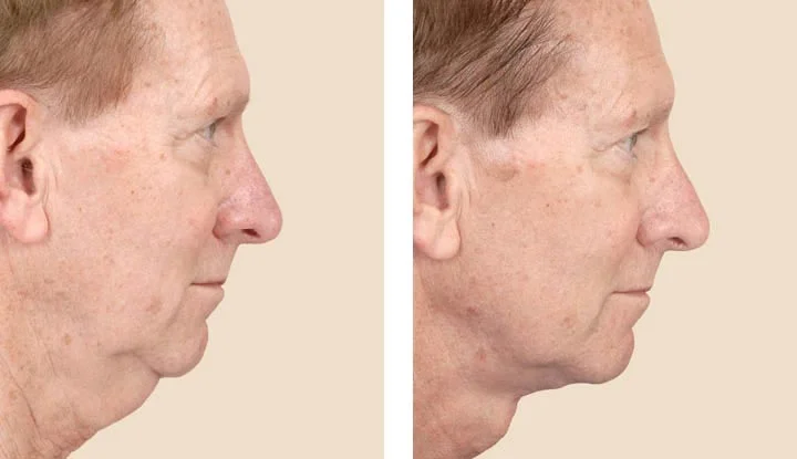 23364-neck-lift-platysmaplasty