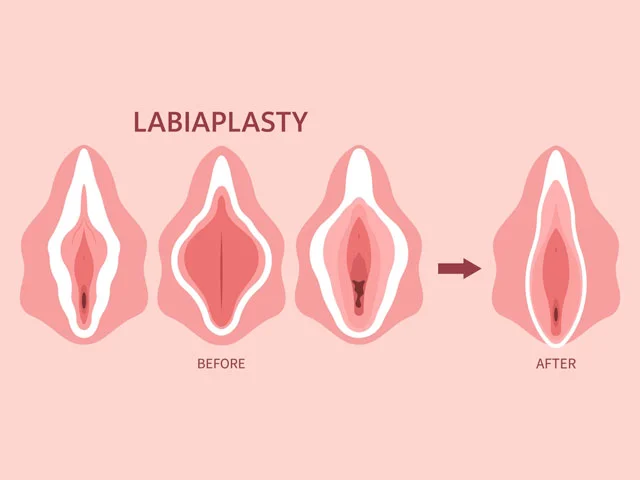 Labiaplasty-Head