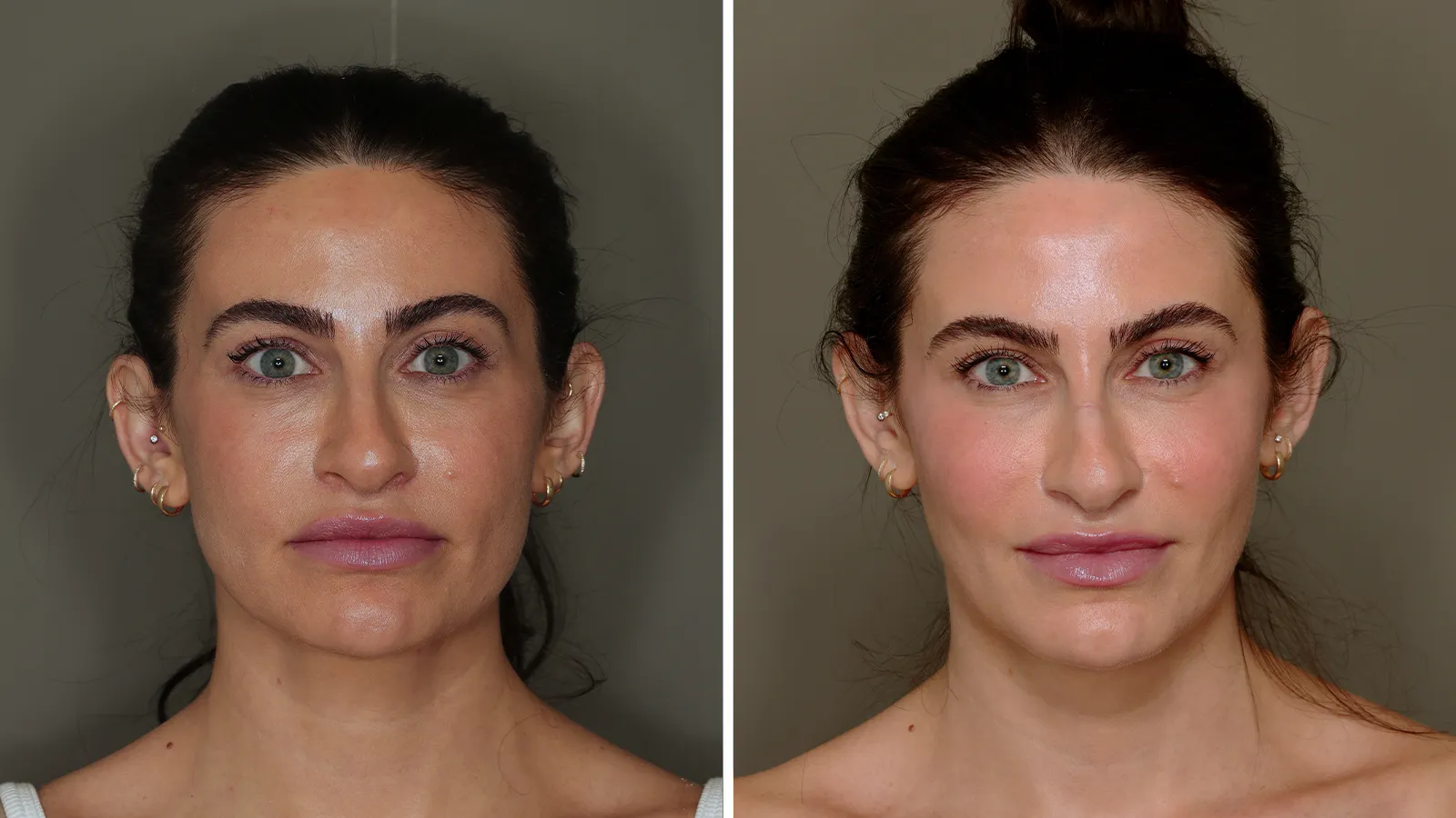 allure-facial-fat-grafting-before-after-1