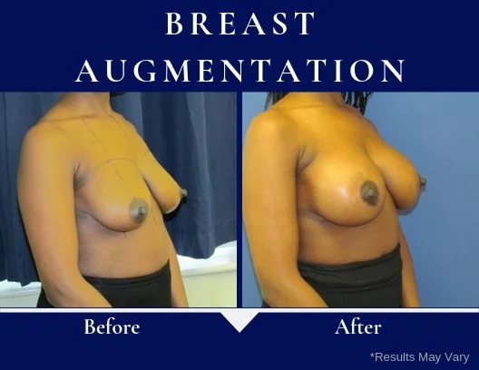 before-after-breast-augmentation-side