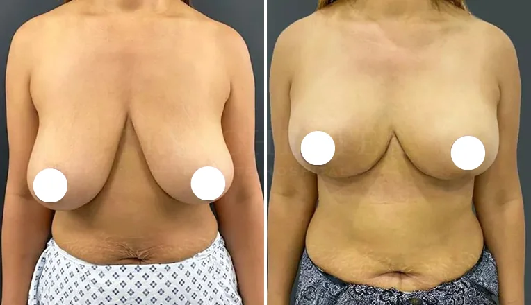 breast-uplift-before-and-after-5-v2