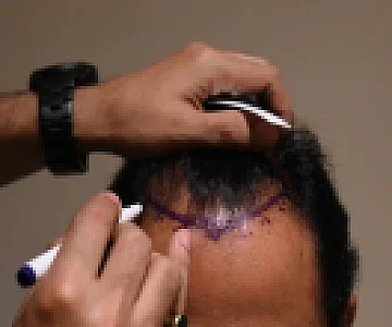 A Sudden Death Leads To Focus On Risky Hair Transplants In India